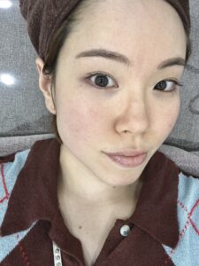 ジェネシス施術