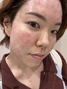 ドクターエバーズでの施術後