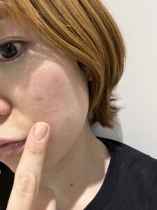 リポットレーザー前