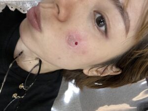 リポットレーザー跡