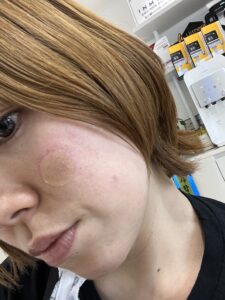 リポットレーザーダウンタイム