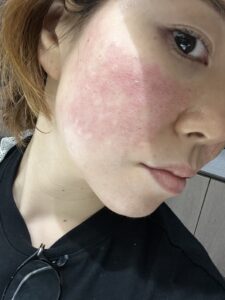 ドクターエバーズでの施術後