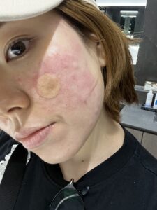 ドクターエバーズでの施術後