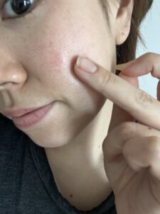 リポットレーザー後