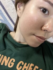 ドクターエバーズでの施術後ダウンタイム明けの肌