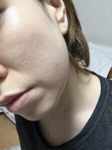 リポットレーザー後