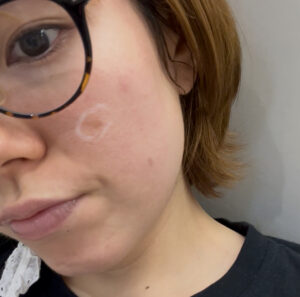 リポットレーザーカウンセリング